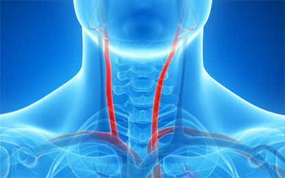 Carotid Angioplasty